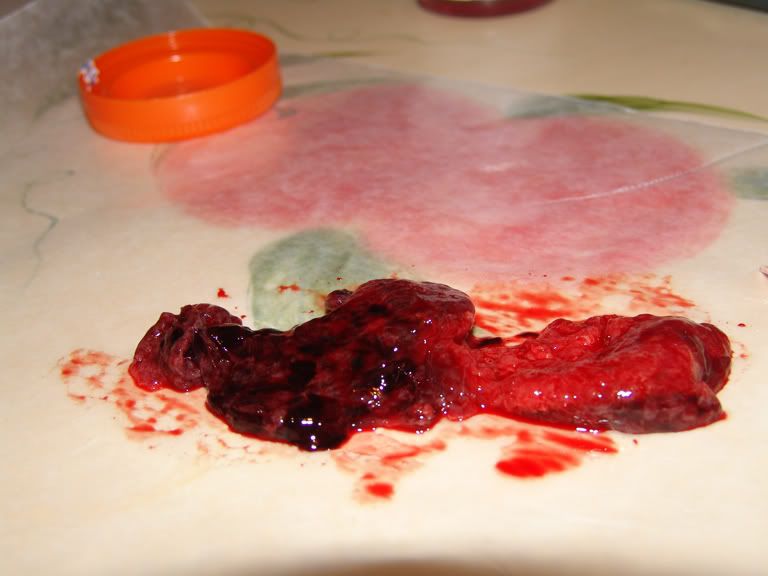 Blood Clots Miscarriage